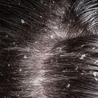 Dandruff