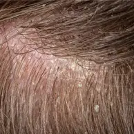 Dry Scalp