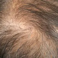 Hair Thinning