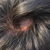 Male Pattern Baldness