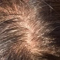 Oily Scalp