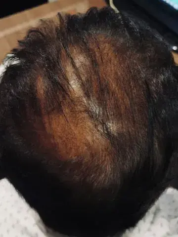 pattern baldness after