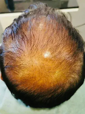 pattern baldness before