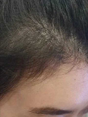 hair loss after